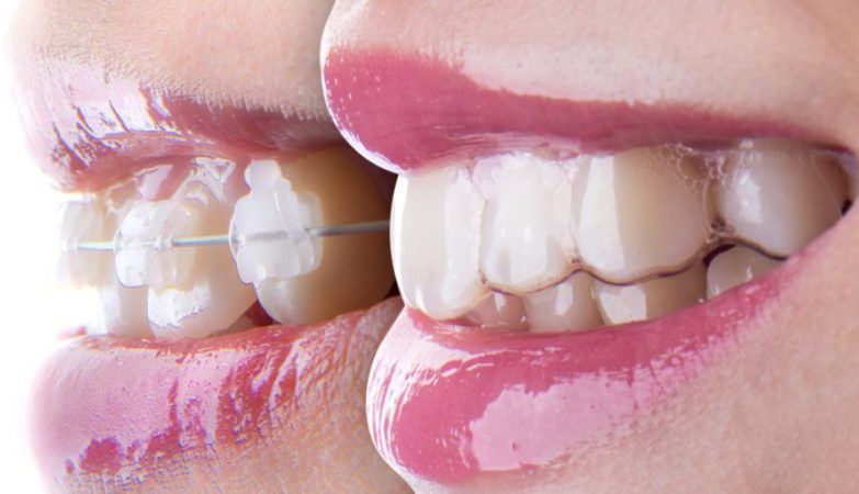 does insurance cover invisalign